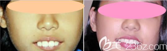 沈阳百嘉丽牙科青少年牙齿矫正效果图 沈阳百嘉丽牙科青少年牙齿矫正效果图