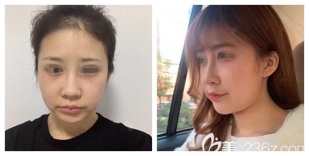 面诊南通维多利亚术前大腮帮子 面诊南通维多利亚术前大腮帮子