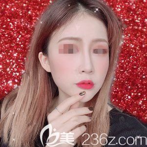 刚注射完瘦脸术后4天 刚注射完瘦脸术后4天