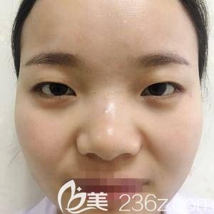 骆豫医生的双眼皮整形案例