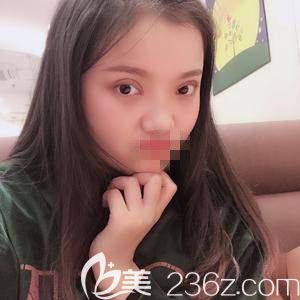 全切双眼皮术后7天