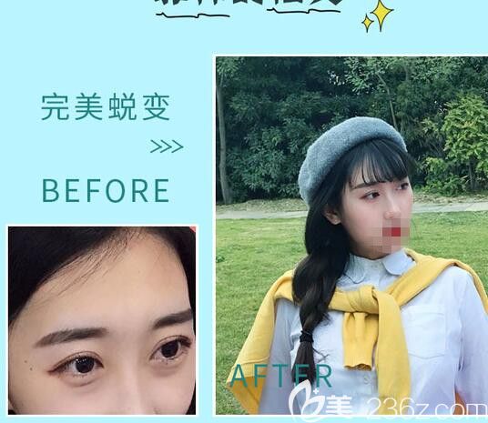 骆豫医生顾客 祛眼袋手术前后对比照片