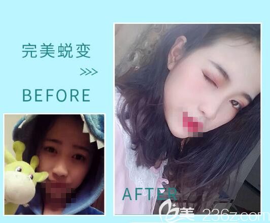 骆豫医生顾客 鼻综合手术前后对比照片