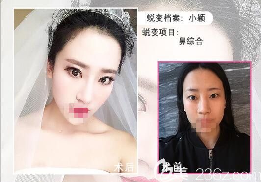 骆豫医生顾客 鼻综合手术前后对比照片