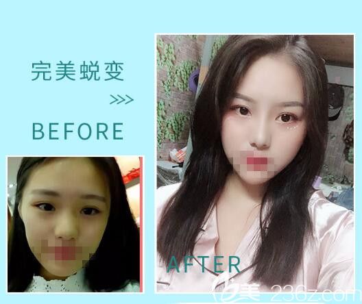 骆豫医生顾客 自体脂肪填充前后对比照片