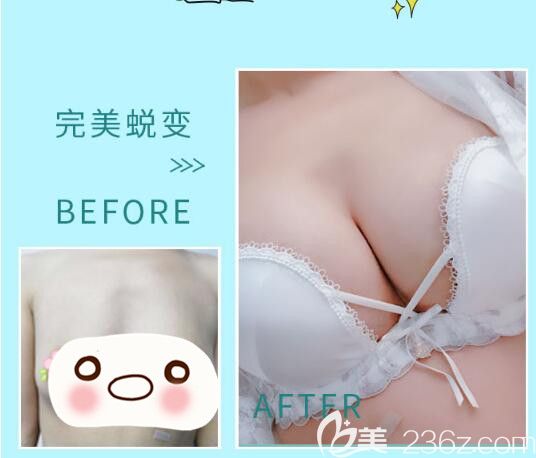 骆豫医生顾客 假体隆胸填充前后对比照片
