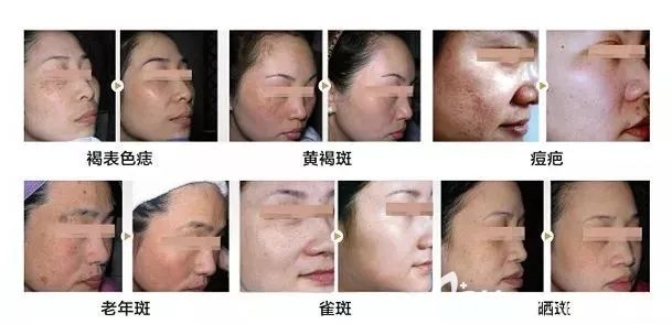 苏州康美皮秒祛斑案例