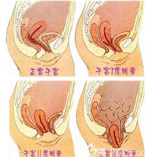 正常子宫与子宫下垂级别化分示意图