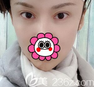 对比了几家医院后选了韩国芭堂整形医院做了失败双眼皮修复后3个月就告别了眼睛疤痕