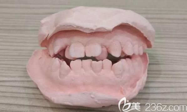 深覆颌矫正前取牙模的样子 深覆颌矫正前取牙模的样子