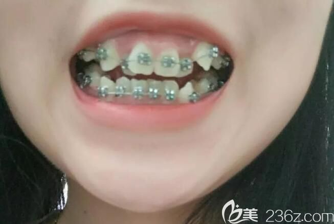 在聊城口腔医院矫正深覆合24天 在聊城口腔医院矫正深覆合24天