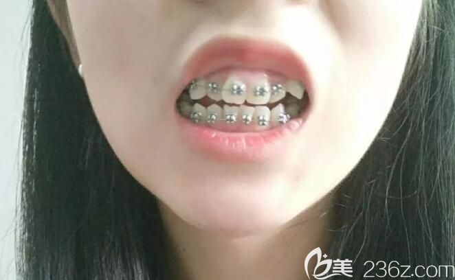 高景梅矫正深覆合<span style= 高景梅矫正深覆合<span style=