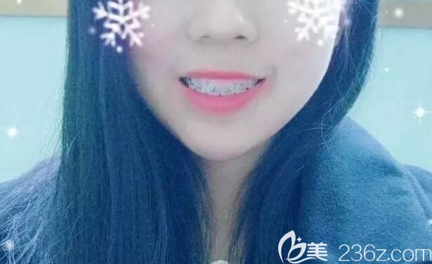 牙齿矫正快4个月 牙齿矫正快4个月