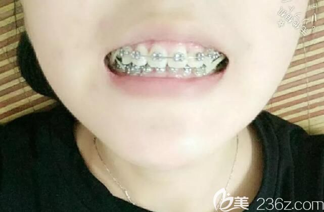 聊城口腔医院带牙套328天 聊城口腔医院带牙套328天
