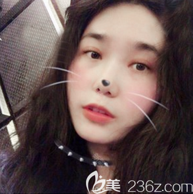 东莞壹加壹梅小霞割双眼皮案例 东莞壹加壹梅小霞割双眼皮案例