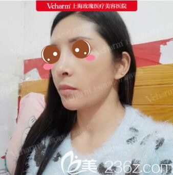 上海玫瑰医疗美容医院王晨光自体脂肪面部填充真人案例术后第15天
