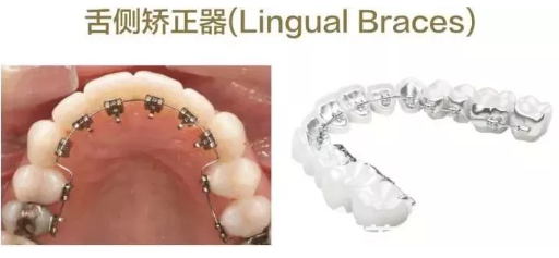 舌侧矫治器