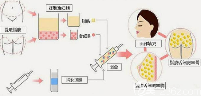 自体脂肪移植过程 自体脂肪移植过程