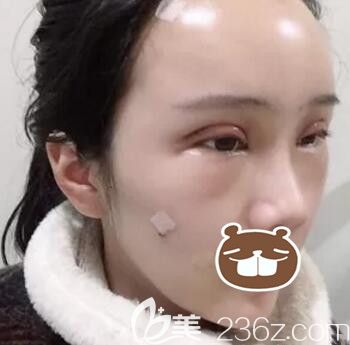 在长沙亚韩做双眼皮+全脸脂肪填充术后当天效果
