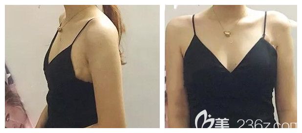 我在南宁美丽星整形做隆胸手术前的照片 我在南宁美丽星整形做隆胸手术前的照片