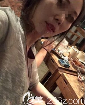 在韩国遇见美做颧骨整形手术前 在韩国遇见美做颧骨整形手术前