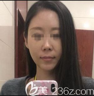 在韩国遇见美做颧骨整形手术后10天 在韩国遇见美做颧骨整形手术后10天