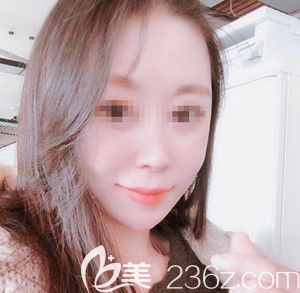 在韩国遇见美做无钛钉颧骨颧弓整形手术5个月的恢复过程分享