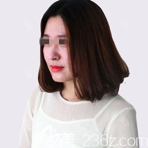 在张家口维多利亚做自体脂肪丰胸术前是b罩杯 在张家口维多利亚做自体脂肪丰胸术前是b罩杯