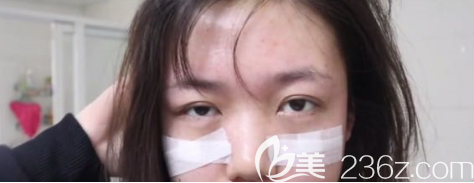 术后第5天的眼部状况 术后第5天的眼部状况