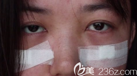 术后第10天的眼部状况 术后第10天的眼部状况