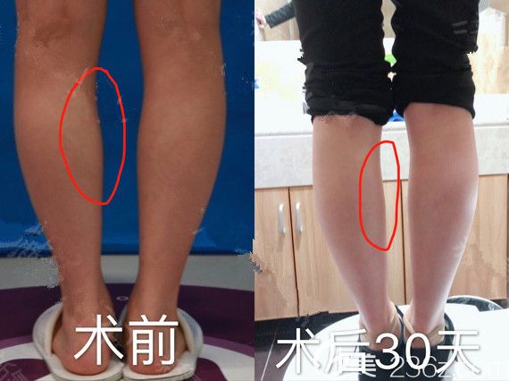 多年高跟鞋穿出来的肌肉小粗腿到南京美莱注射国产兰州瘦腿30分钟就搞定 还有详细护理注意事项公开
