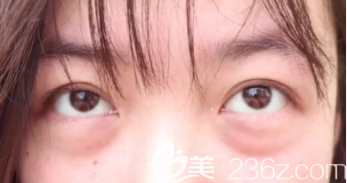 术前我的眼袋+泪沟样子 术前我的眼袋+泪沟样子