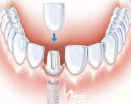 洛阳九龙口腔郑淑敏介绍单颗牙缺失需要及时修复 洛阳九龙口腔郑淑敏介绍单颗牙缺失需要及时修复