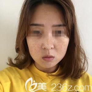 在张家口维多利亚做激光祛斑前满脸雀斑 在张家口维多利亚做激光祛斑前满脸雀斑