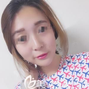 在张家口维多利亚做激光祛斑术后一周雀斑消失 在张家口维多利亚做激光祛斑术后一周雀斑消失