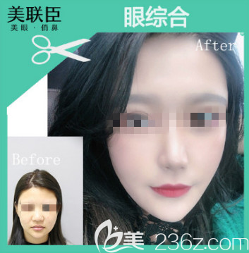 大概2月底去淄博做了去眼袋手术恢复了4个月了，我今天分享我的照片+心得