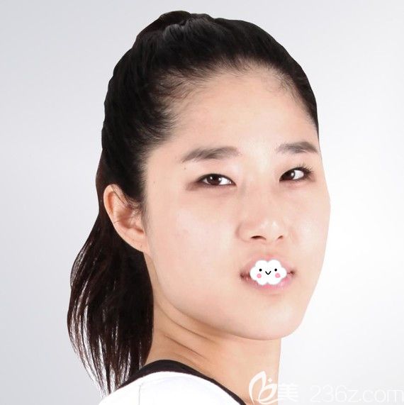 韩国菲斯莱茵Faceline整形医院隆鼻失败修复+双鄂手术真人案例 韩国菲斯莱茵Faceline整形医院隆鼻失败修复+双鄂手术真人案例