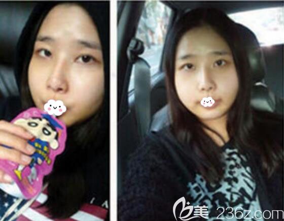 韩国菲斯莱茵Faceline面部轮廓术后5天恢复效果图 韩国菲斯莱茵Faceline面部轮廓术后5天恢复效果图