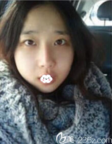 韩国Faceline隆鼻修复+双鄂手术案例术后恢复照片 韩国Faceline隆鼻修复+双鄂手术案例术后恢复照片