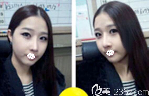 韩国菲斯莱茵Faceline鼻修复+面部轮廓整形术后1个月恢复效果 韩国菲斯莱茵Faceline鼻修复+面部轮廓整形术后1个月恢复效果