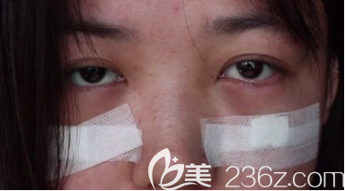 术后第3天 术后第3天