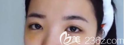 菏泽华美做去眼袋和自体脂肪填充手术都挺好的，分享我术后三个月的恢复情况