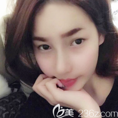 在广州军美做双眼皮术前照片 在广州军美做双眼皮术前照片