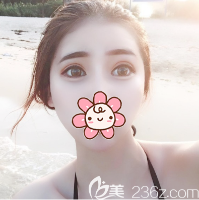 双眼皮眼综合术后一个月恢复效果 双眼皮眼综合术后一个月恢复效果