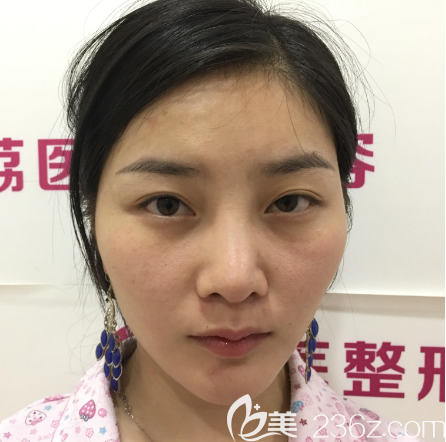 在广州荔医做双眼皮的术前照片 在广州荔医做双眼皮的术前照片