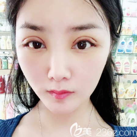 全切双眼皮术后两天恢复效果图 全切双眼皮术后两天恢复效果图