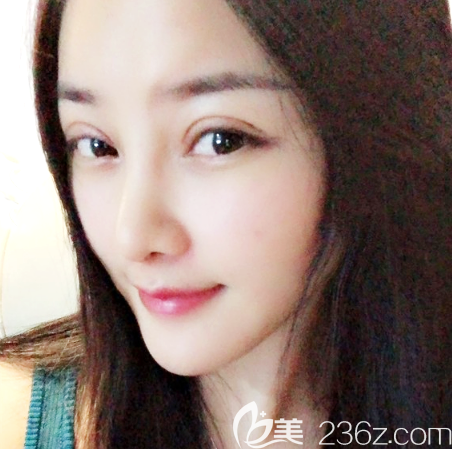 邹顺禄全切双眼皮术后四天消肿效果图 邹顺禄全切双眼皮术后四天消肿效果图