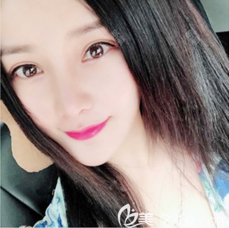 广州荔医邹顺禄医生做的全切双眼皮案例 广州荔医邹顺禄医生做的全切双眼皮案例