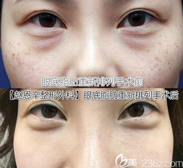 韩国赵恩辛整形网红都打卡去黑眼圈去眼袋去眼纹的医院 整形行业新闻话题 美佳网