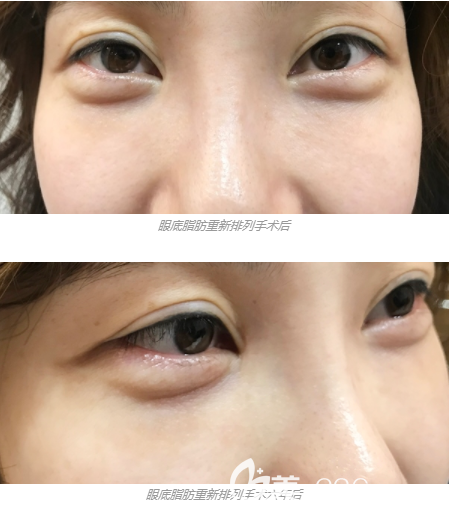 韩国赵恩辛整形网红都打卡去黑眼圈去眼袋去眼纹的医院 整形行业新闻话题 美佳网